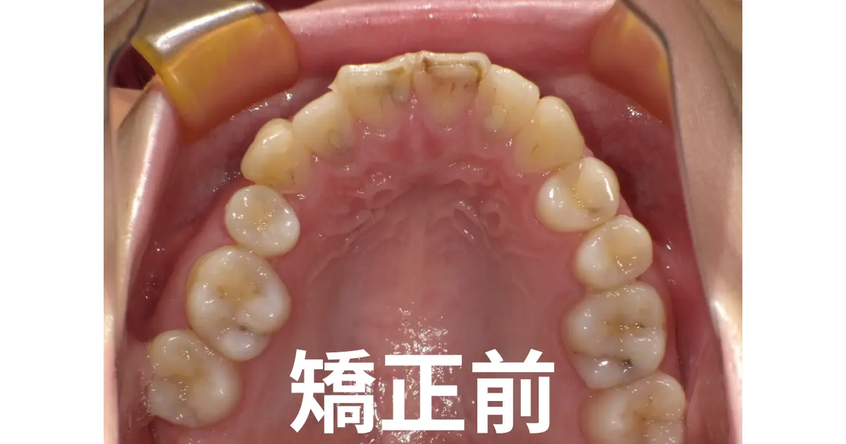 インビザライン矯正前の写真