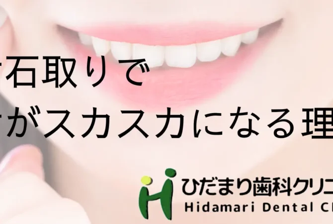 歯石取り