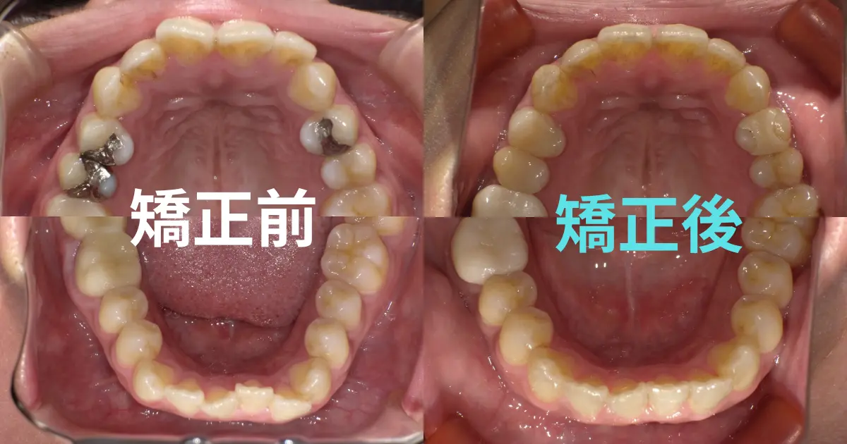 インビザライン矯正前後の写真