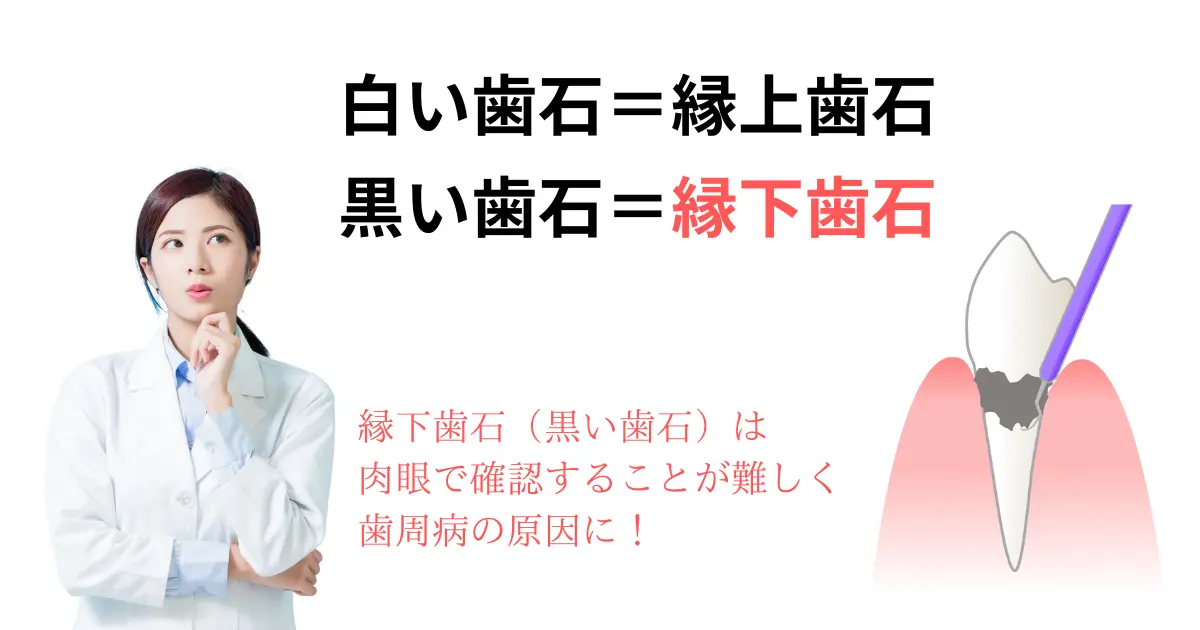 黒い歯石の解説