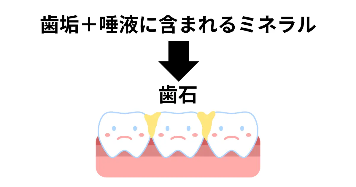 歯石について
