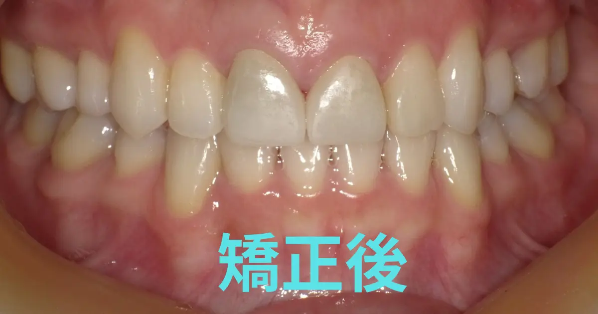 インビザライン矯正後の歯並び（正面）