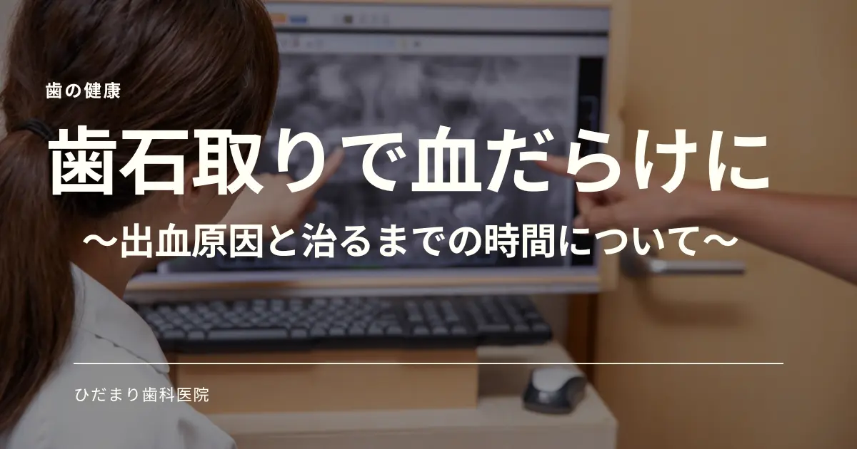 歯石取りで血だらけになっても大丈夫な３つの理由 原因と出血が収まるまでの時間 芦屋市の歯科医院 ひだまり歯科クリニック