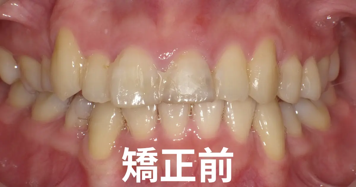 インビザライン矯正前の歯並び（正面）