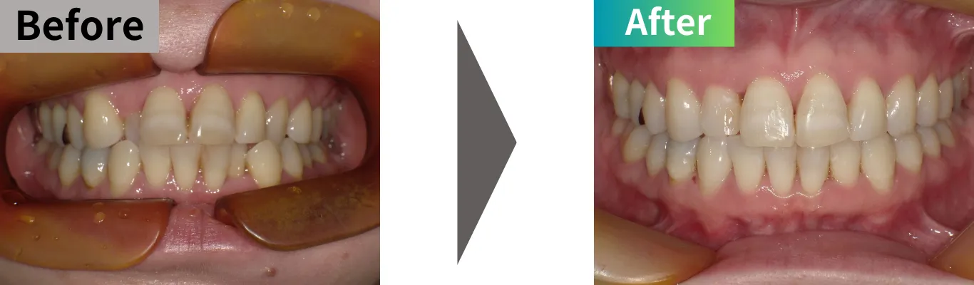 前歯の矯正