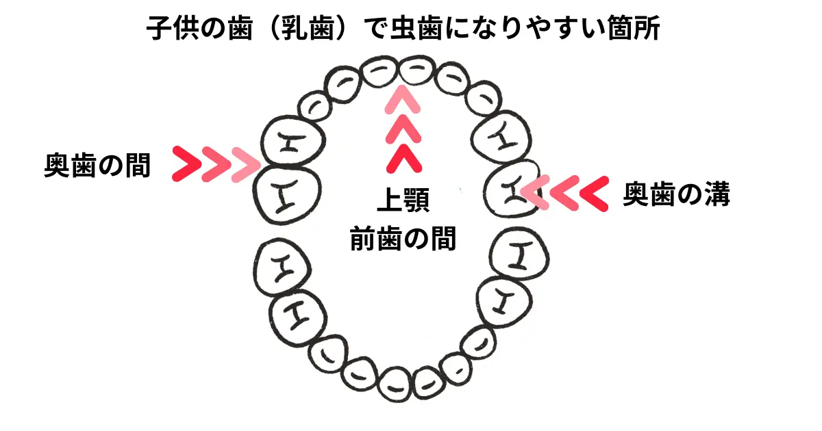 乳歯で虫歯になりやすい箇所